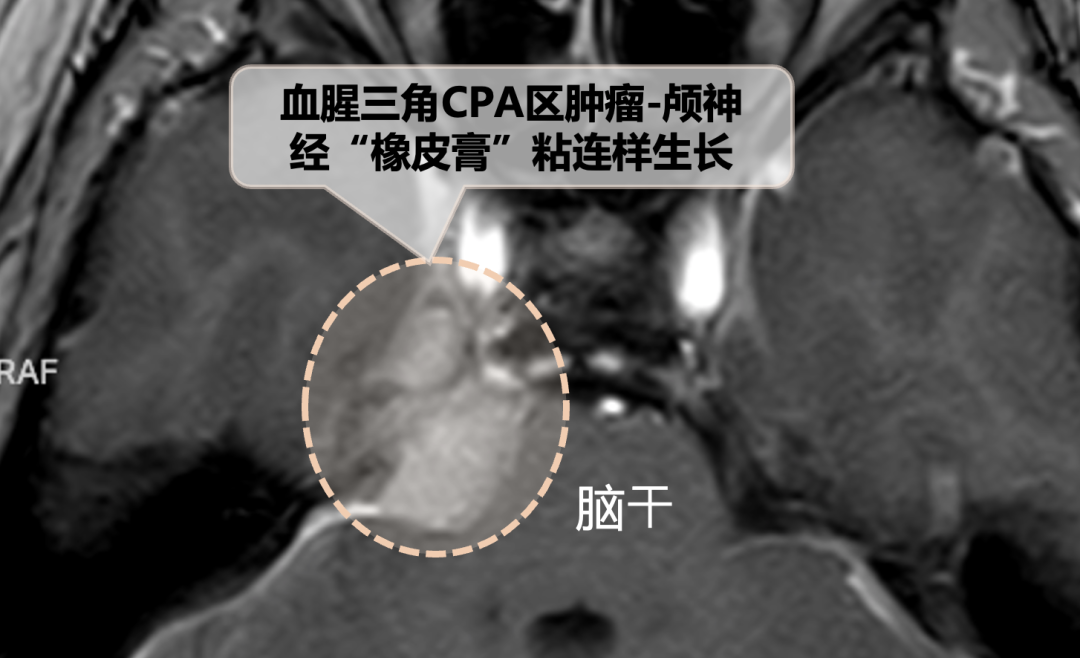 天壇醫(yī)院手術(shù)隨訪(fǎng) | “無(wú)癥狀”腦瘤要不要切？一場(chǎng)手術(shù)讓她
